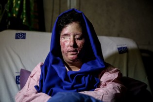 فیلم/ اشک شوق دختر قربانی اسیدپاشی بعد از عمل