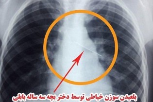 دختر سه سالهای كه سوزن خياطي را قورت داد دختر سه سالهای كه سوزن خياطي را قورت داد