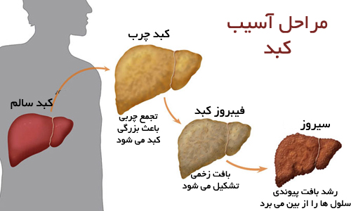 علل ابتلا به کبد چرب علل ابتلا به کبد چرب