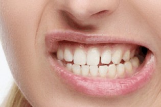 استرس منجر به سایش دندان ها می شود