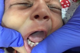 تصویر / 7 دندان نوزاد یکماهه هندی کشیده شد