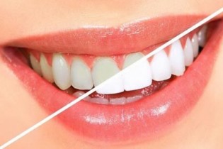 راه های جلوگیری از زردی دندان را بخوانید