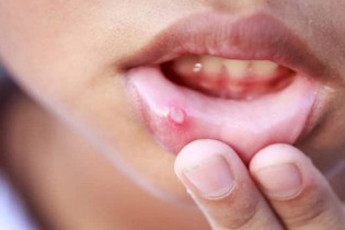 راه های درمان خانگی و دارویی آفت دهان