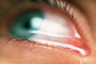 علل آلرژی های چشمی
