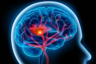 سکته مغزی خطر زوال عقل را افزایش می‌دهد