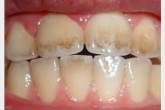 چند ماه یک بار دندان مان را جرم گیری کنیم؟ چند ماه یک بار دندان مان را جرم گیری کنیم؟