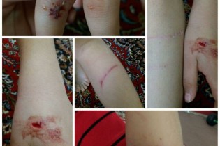 حمله سگ ولگرد به یک کودک ۷ ساله در یک روستا+ عکس