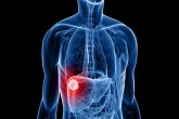 چگونه خطر ابتلا به سرطان کبد را کاهش دهیم؟