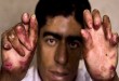بیماری دردناک پوستی سه‌جوان  <img src="/images/picture_icon.gif" width="16" height="13" border="0" align="top">