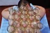 حجامت مواد زاید را از بدن خارج می کند