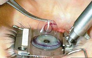 واردات چند تنی چاقو جراحی چشم از ژاپن و کانادا