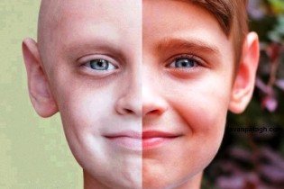 ۸ واقعیت در مورد «سرطان پوست» که باید بدانید