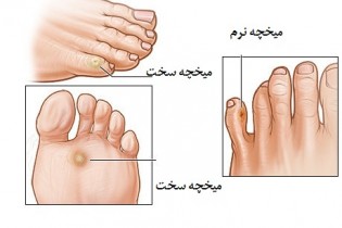 میخچه پا و روش های درمان خانگی آن