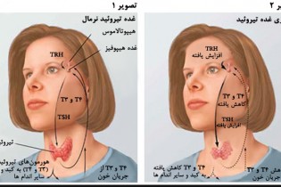 نوع تغذیه بر سلامت تیروئد زنان موثر است