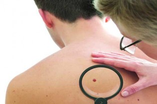 چه موقع خال های قرمز روی پوست خطرناک می شوند؟