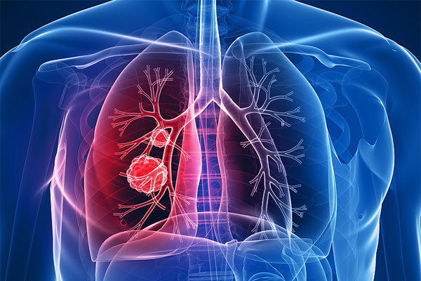 مهم ترین عامل بروز سرطان ریه/مردان بیشتر درگیر می شوند